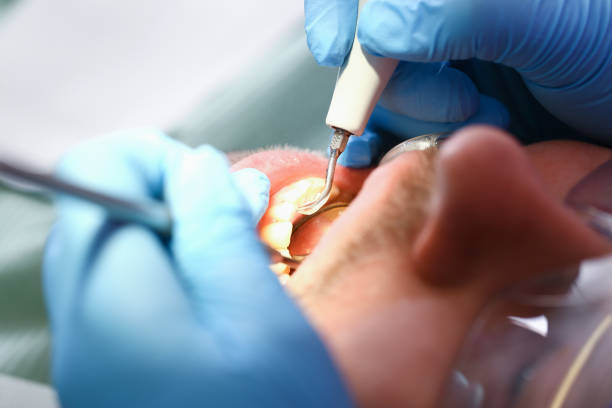 Best Emergency Dentist for Knocked-Out Tooth in Omaha, TX